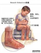 过敏性紫癜的表现有哪些？