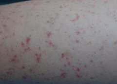 治疗腹型紫癜需要注意哪些？