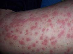 中医治疗过敏性紫癜效果显著吗