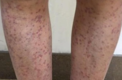 老年人过敏性紫癜的症状