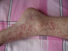 怎么区分过敏性紫癜和血小板减少性紫癜