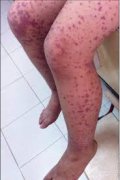 身上冒出不少“小红点”是过敏性紫癜吗？