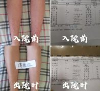 怎样确定紫癜？需要做哪些检查？