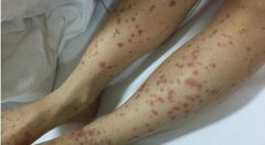 过敏性紫癜临床表现和护理注意