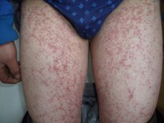 小儿过敏性紫癜如何防复发？
